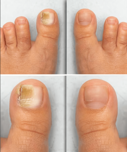Foot fungus - Open-air cream before and after treatment