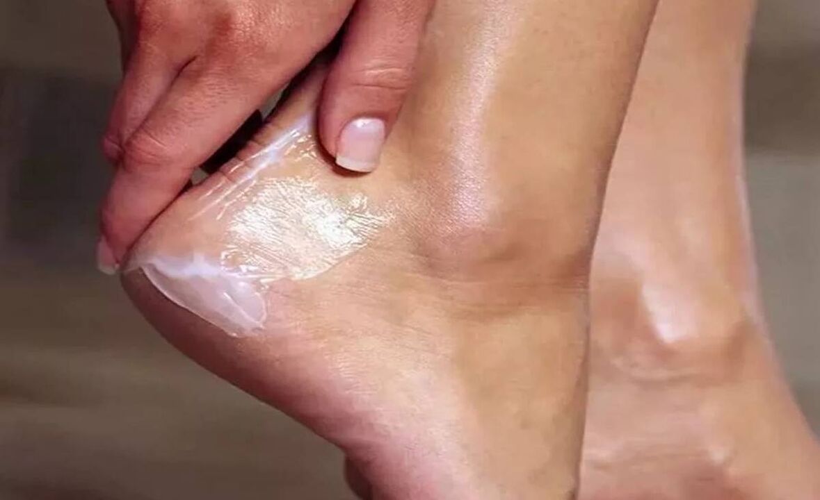 How to treat foot fungus with fun cream