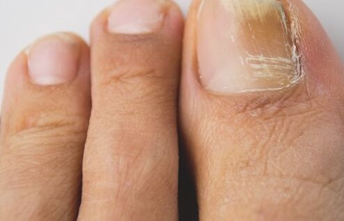Nail fungus