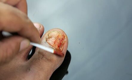 Treatment of the lesion with a mushroom