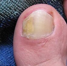 fungus