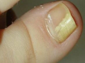 A sick nail