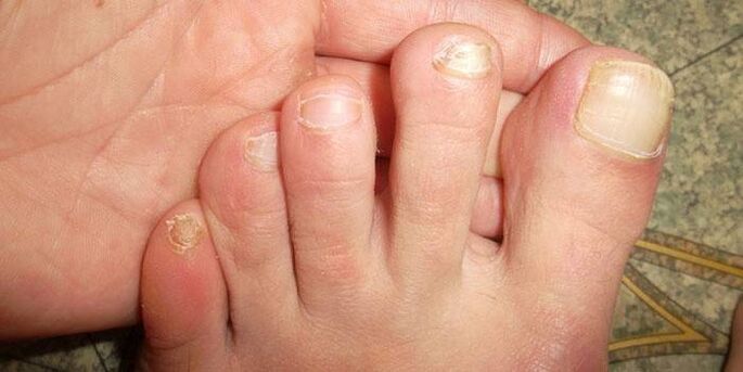 Speaking of the nail after an injury