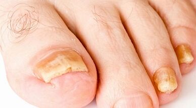 How to treat the nail fungus
