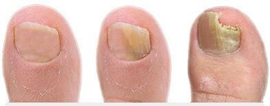 Phase of the development of the mushroom on the nails