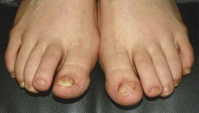 Signs and symptoms of mushrooms on the nails