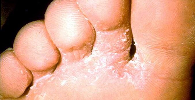 Lesion of the mushroom of the skin between the fingers of the feet