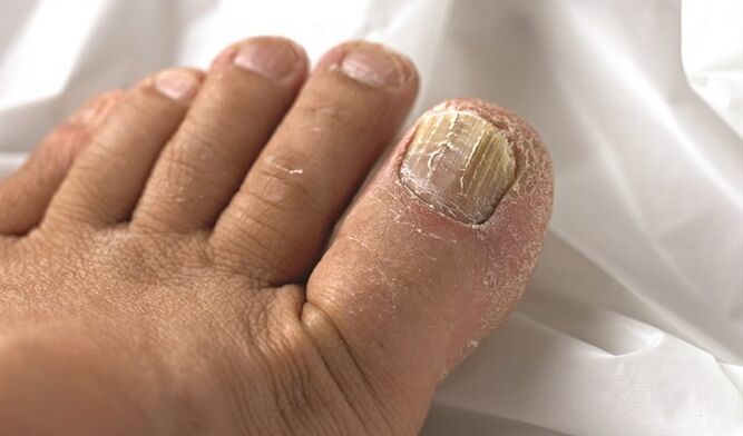 Spread the mycologio lesion on the nail plate