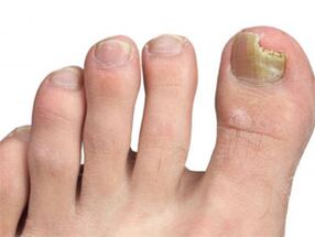 Yellow spots on the nails of the signs of the foot foot