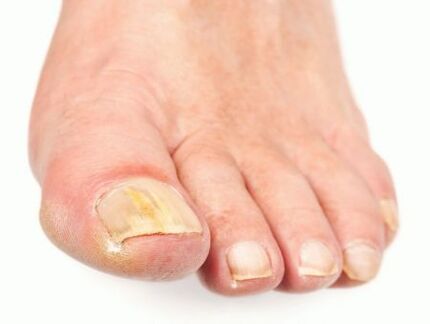 fungal damage to nails