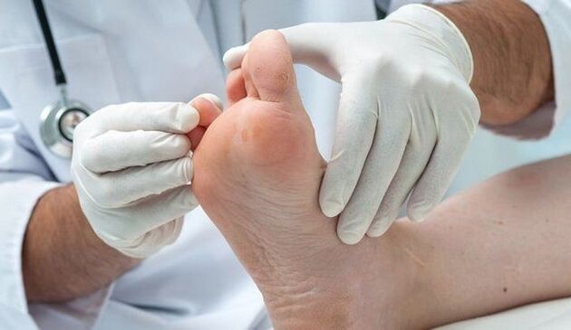 treatment and diagnosis of the fungus by a doctor
