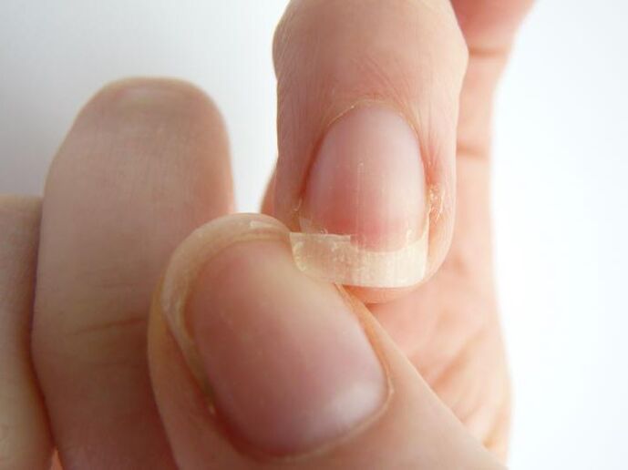 detachment of the nail due to fungi