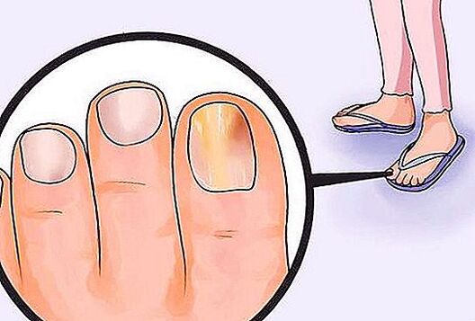 fungus on toenails