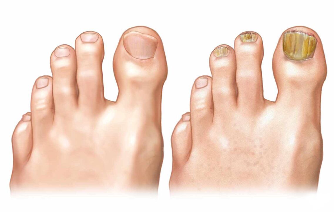 healthy nails and toenail fungus
