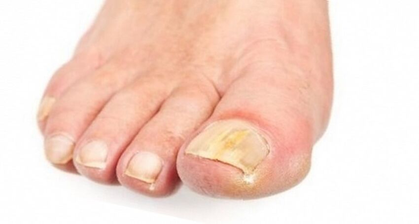yellowing of the nail due to fungi