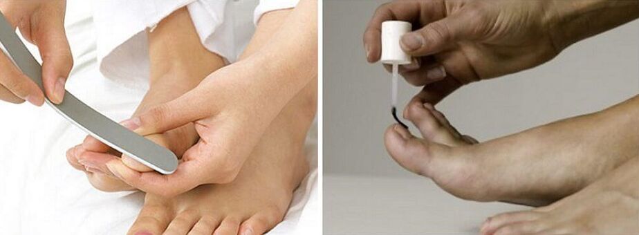treatment of fungus on toenails with varnish