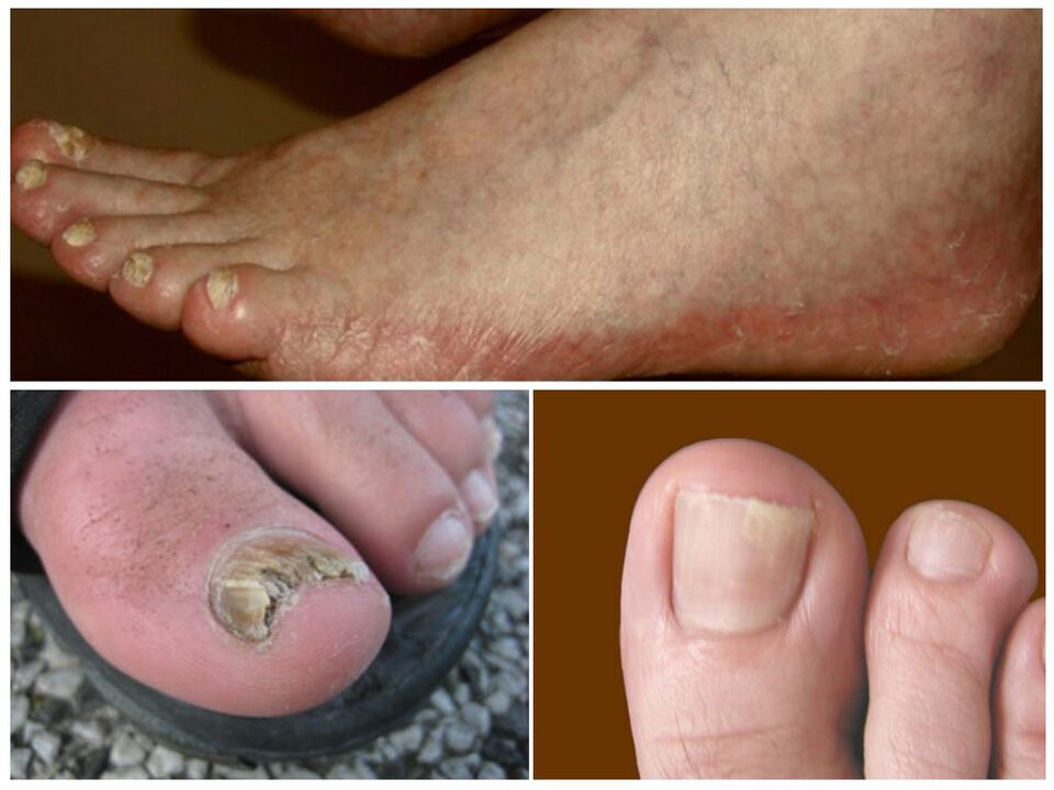Types of foot fungi